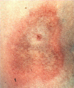 tick bites